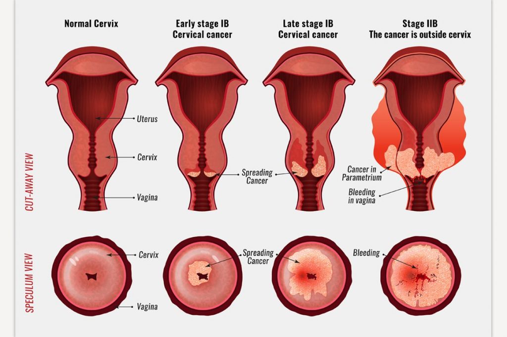 Warning Signs of Cervical Cancer