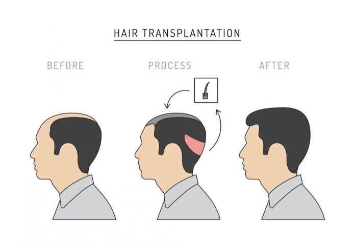 How successful is a hair transplant? - Healths Digest