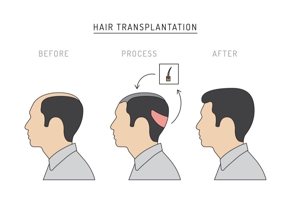 How successful is a hair transplant?