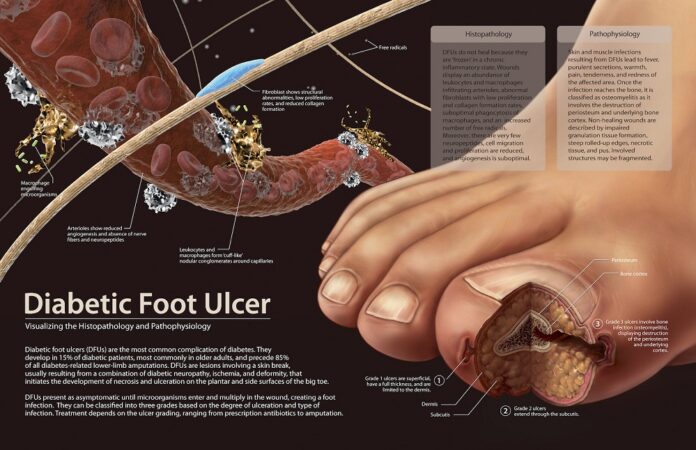 diabetic foot ulcer