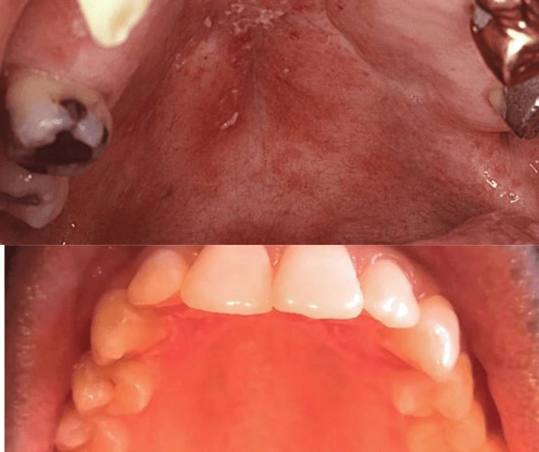 Roof Of Mouth Itchy Common Sign 5 Causes And Treatment