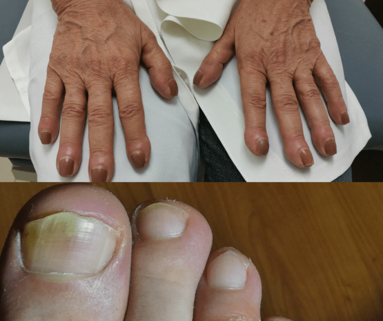 does-kidney-disease-nails-cause-problems-with-nails-sit