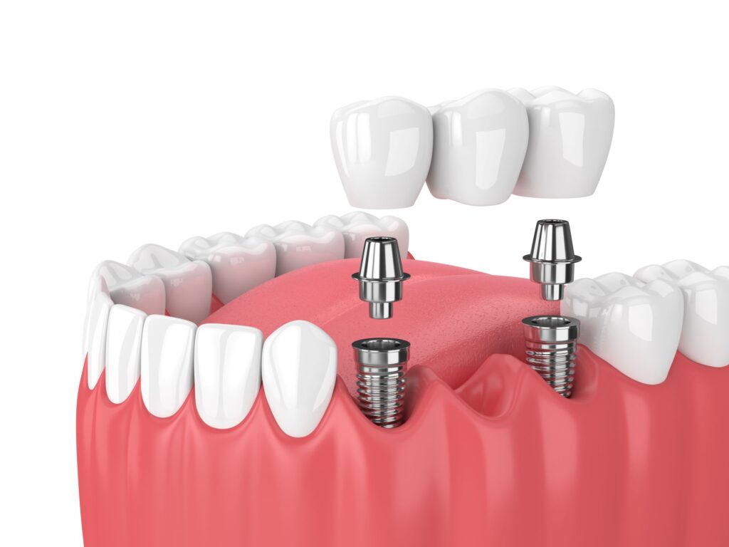 Diş implantları